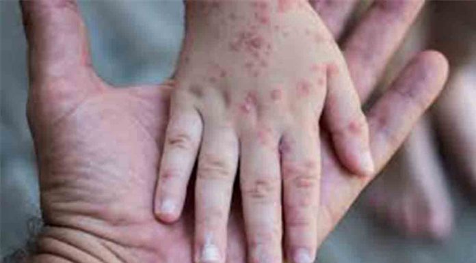 La Agencia de Salud Pública pide extremar las precauciones para prevenir la viruela del mono La Agencia de Salud Pública pide extremar las precauciones para prevenir la viruela del mono