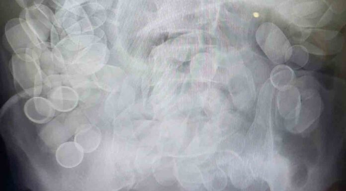 Detenido en el aeropuerto con 153 cilindros de cocaína en el estómago Detenido en el aeropuerto con 153 cilindros de cocaína en el estómago