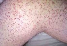 El Hospital de Bellvitge alerta del retorno del escorbuto El Hospital de Bellvitge alerta del retorno del escorbuto