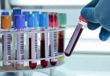 Un test en sangre pionero anticipa la evolución hacia el Alzhéimer Un test en sangre pionero anticipa la evolución hacia el Alzhéimer
