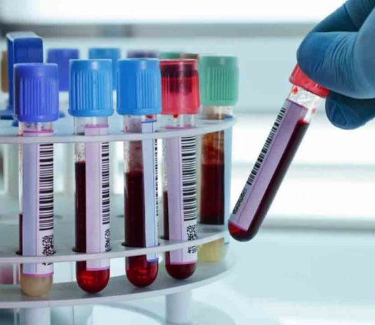 Un test en sangre pionero anticipa la evolución hacia el Alzhéimer Un test en sangre pionero anticipa la evolución hacia el Alzhéimer